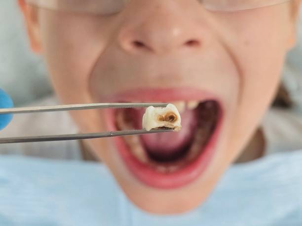 Best Emergency Tooth Extraction in Lamar, MO